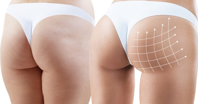 What Are A Brazilian Butt Lifts and its benefits?
